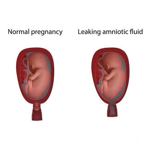 amniotic.fluid leaking|Leaking Amniotic Fluid During Pregnancy